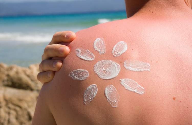 ۱۵ درمان فوری برای آفتاب‌سوختگی‌ در تابستان