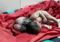 نوزادی با 3 سر در هند به دنیا آمد