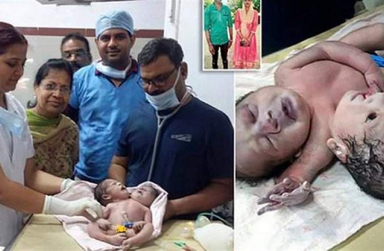 تولد یک نوزاد با دو سر و سه دست در هند
