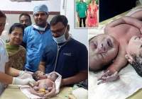 تولد یک نوزاد با دو سر و سه دست در هند