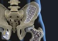 The global burden of osteoporosis has doubled in the last 30 years