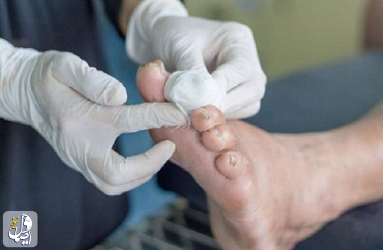 افزایش کلینیک‌های دولتی برای زخم پای دیابتی در اصفهان ضروریست