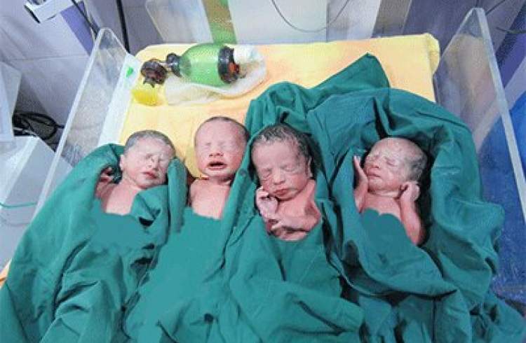 چهارقلوهای کالپوشی در بیمارستان شاهرود سمنان به دنیا آمدند