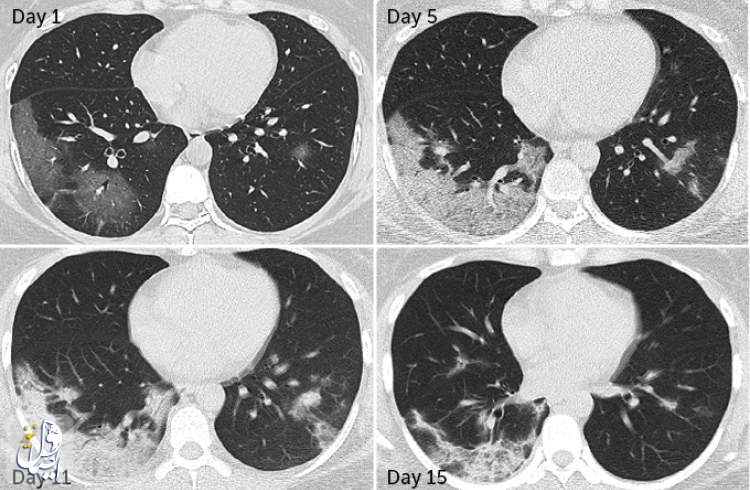 روش موثر درمان ریه ها پس از بهبودی از کووید-19 اعلام شد