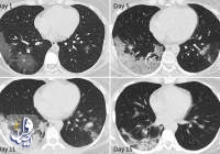 روش موثر درمان ریه ها پس از بهبودی از کووید-19 اعلام شد