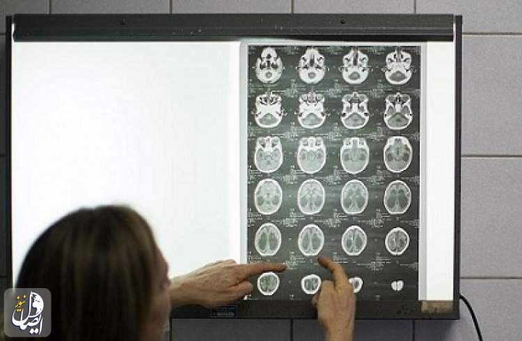 یافته جدید دانشمندان از آسیب های کرونا به مغز
