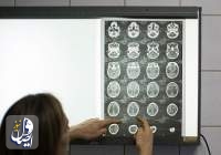 یافته جدید دانشمندان از آسیب های کرونا به مغز