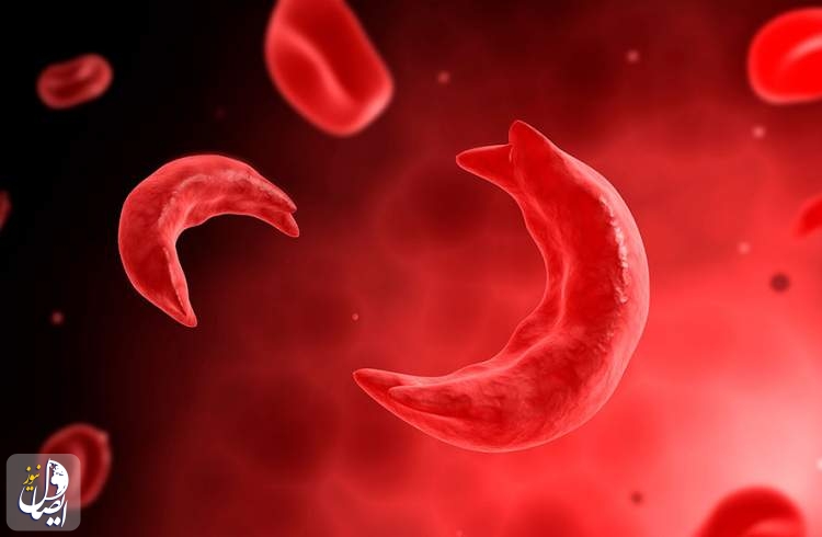 Sickle-cell gene therapies offer hope — and challenges