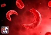 Sickle-cell gene therapies offer hope — and challenges