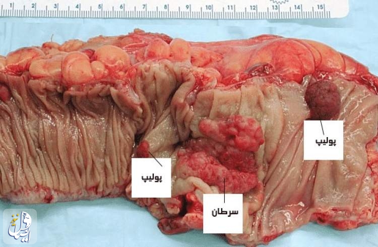 علائم سرطان روده را بشناسید