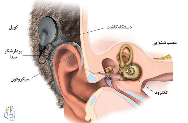 کاشت رایگان حلزون شنوایی برای کودکان ناشنوا