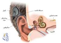 کاشت رایگان حلزون شنوایی برای کودکان ناشنوا
