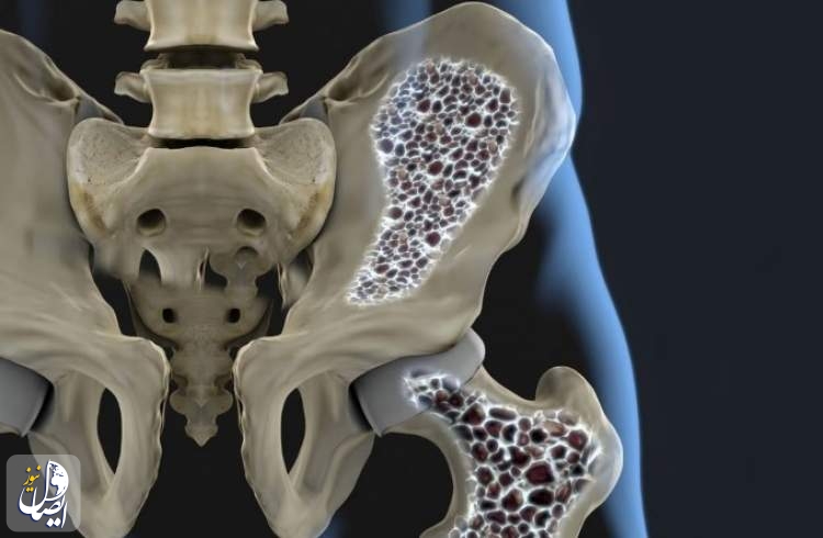 The global burden of osteoporosis has doubled in the last 30 years